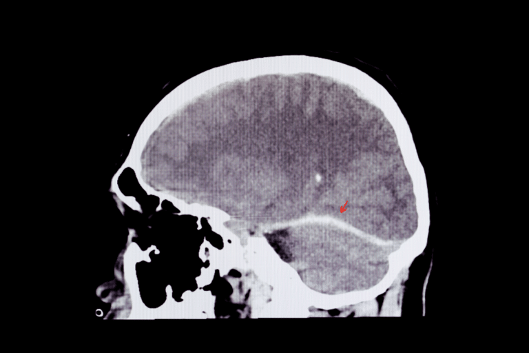 X Ray of the brain