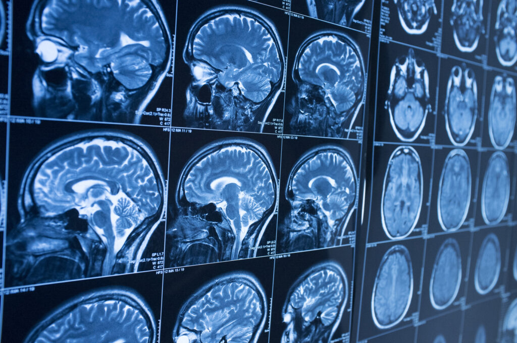 Delayed Concussion Symptoms 