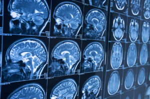 Why Choose Feller & Wendt, LLC If You’ve Suffered a Brain Injury in St. George, UT?